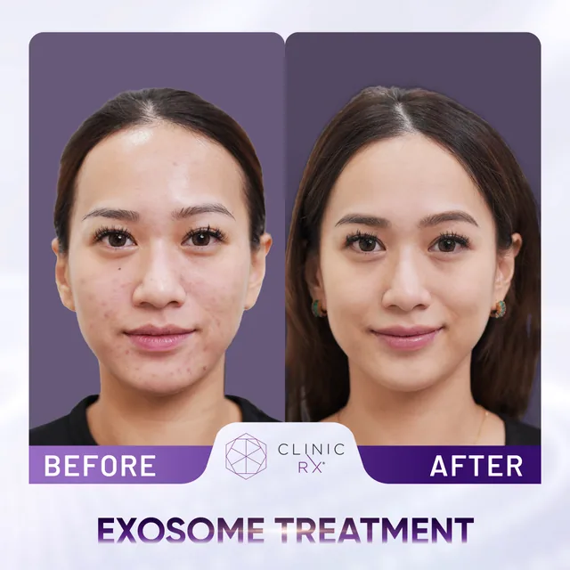 Exosome Therapy actual result 3