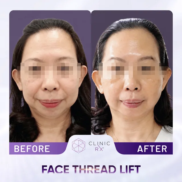 Face Thread Lift actual result 1