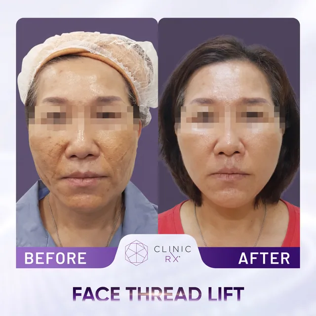 Face Thread Lift actual result 2