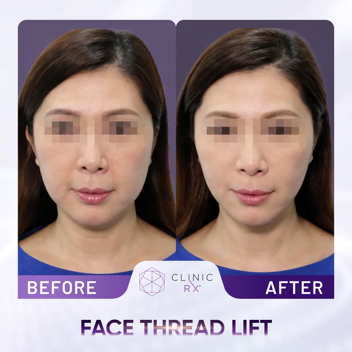 Face Thread Lift actual result 3