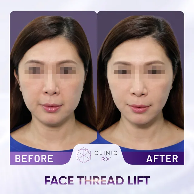 Face Thread Lift actual result 3