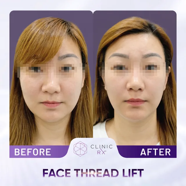 Face Thread Lift actual result 4