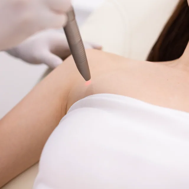 Fotona TightSculpting treatment step 4