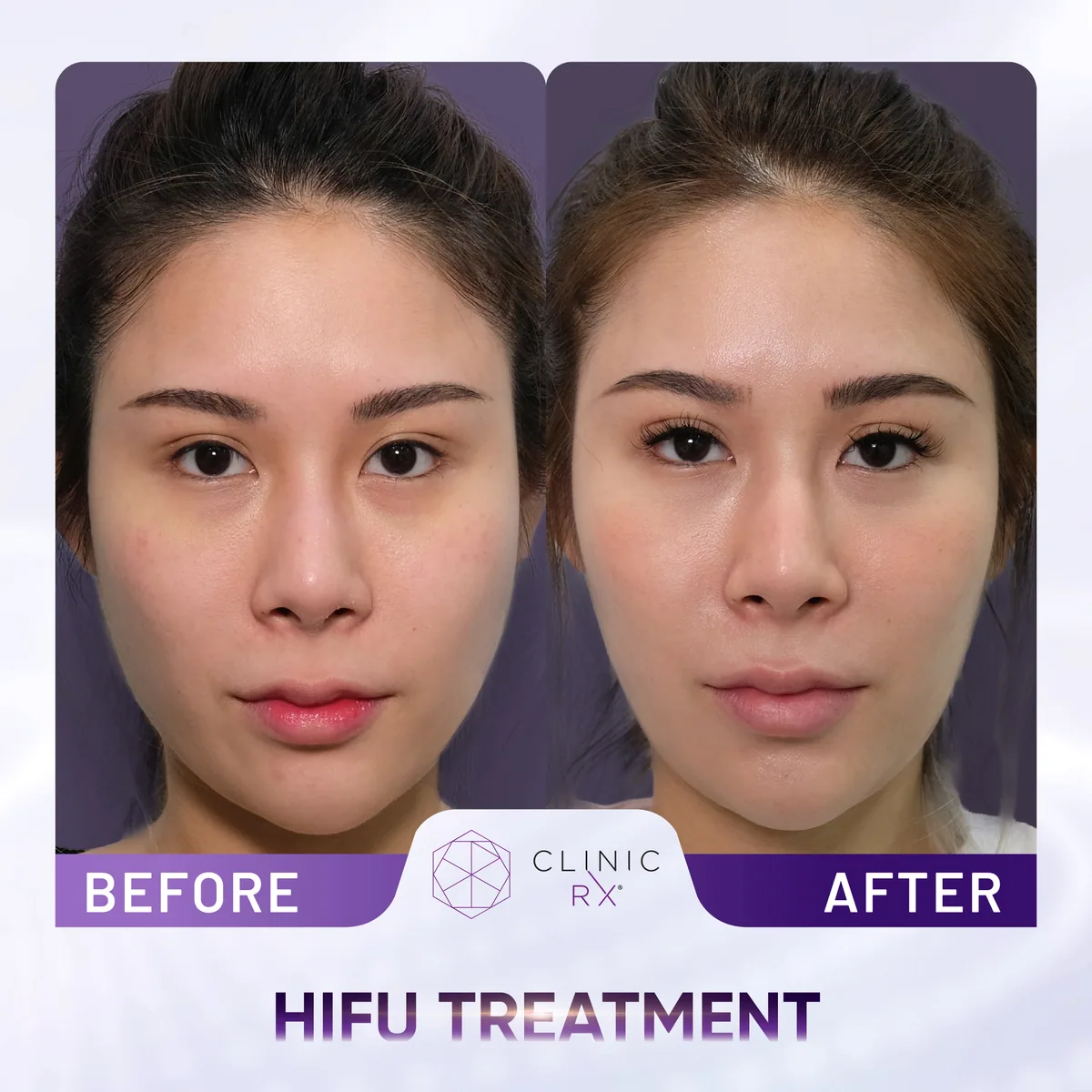 HIFU Ultracel Q+ actual result 1