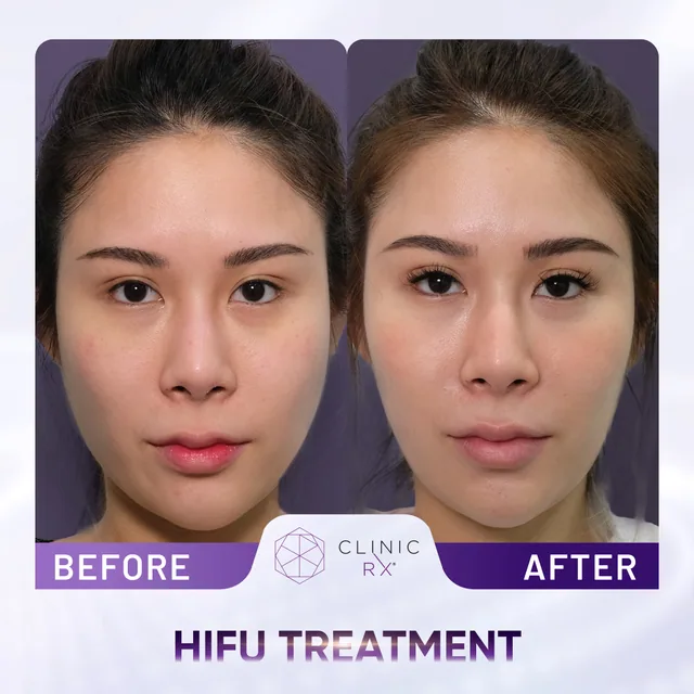 HIFU Ultracel Q+ actual result 1