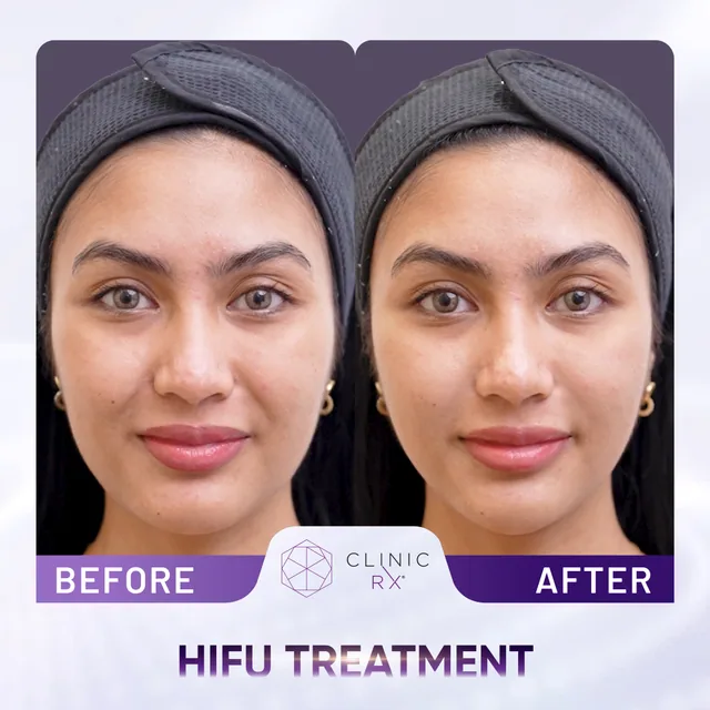 HIFU Ultracel Q+ actual result 2