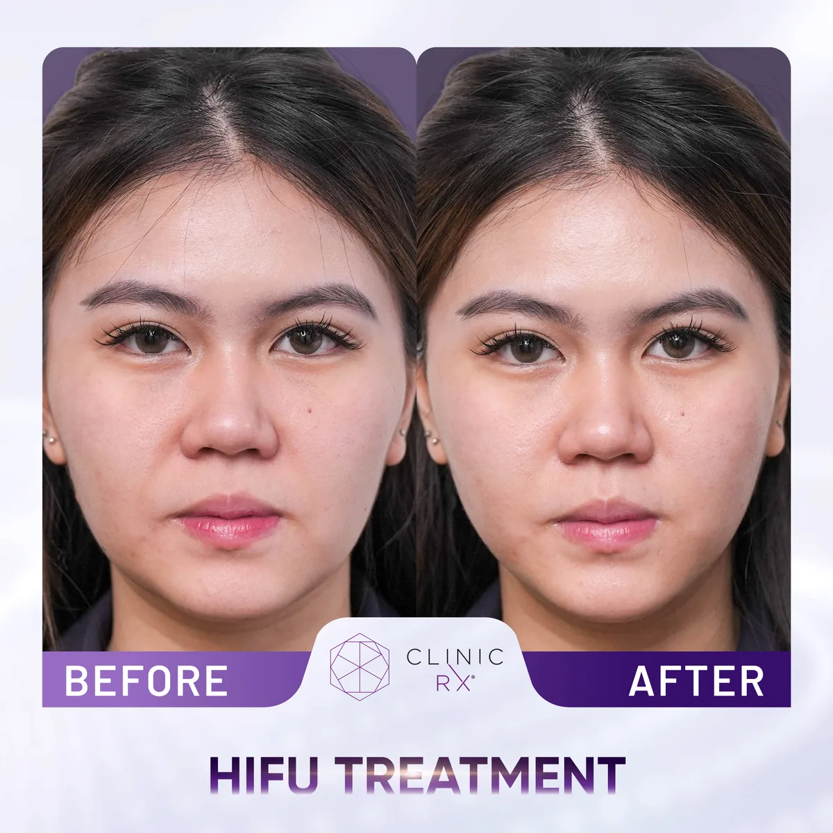 HIFU Ultracel Q+ actual result 3