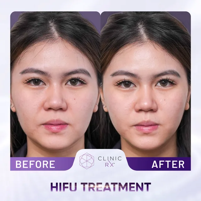 HIFU Ultracel Q+ actual result 3