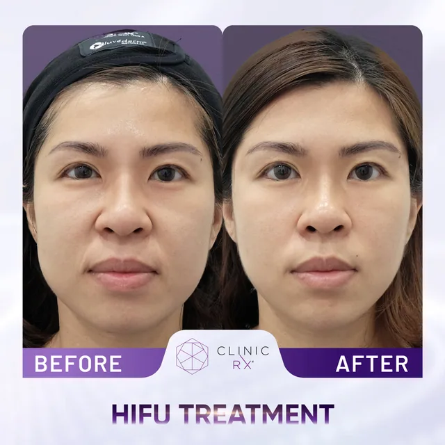 HIFU Ultracel Q+ actual result 4