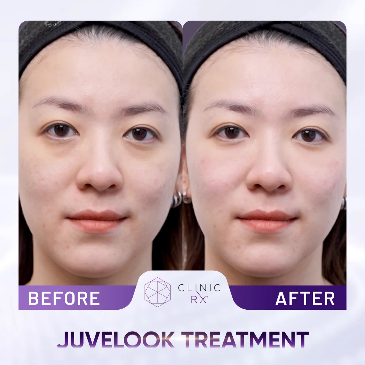 Juvelook actual result 1