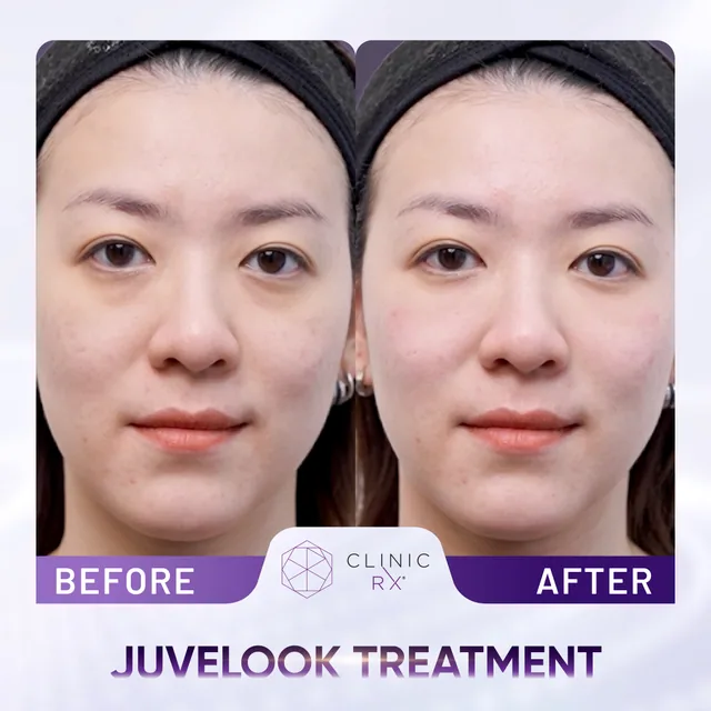Juvelook actual result 1