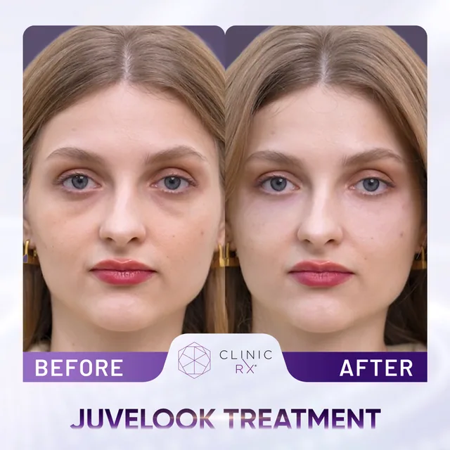 Juvelook actual result 2