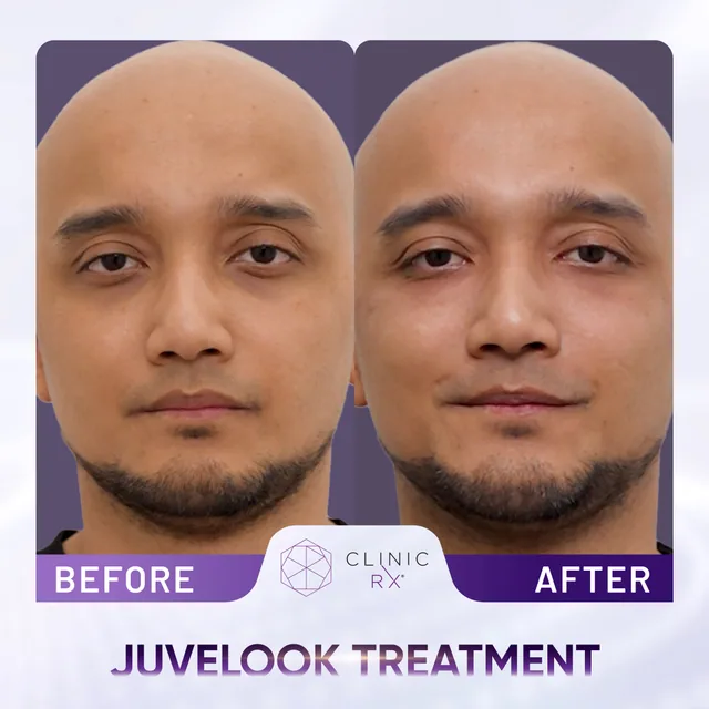 Juvelook actual result 3