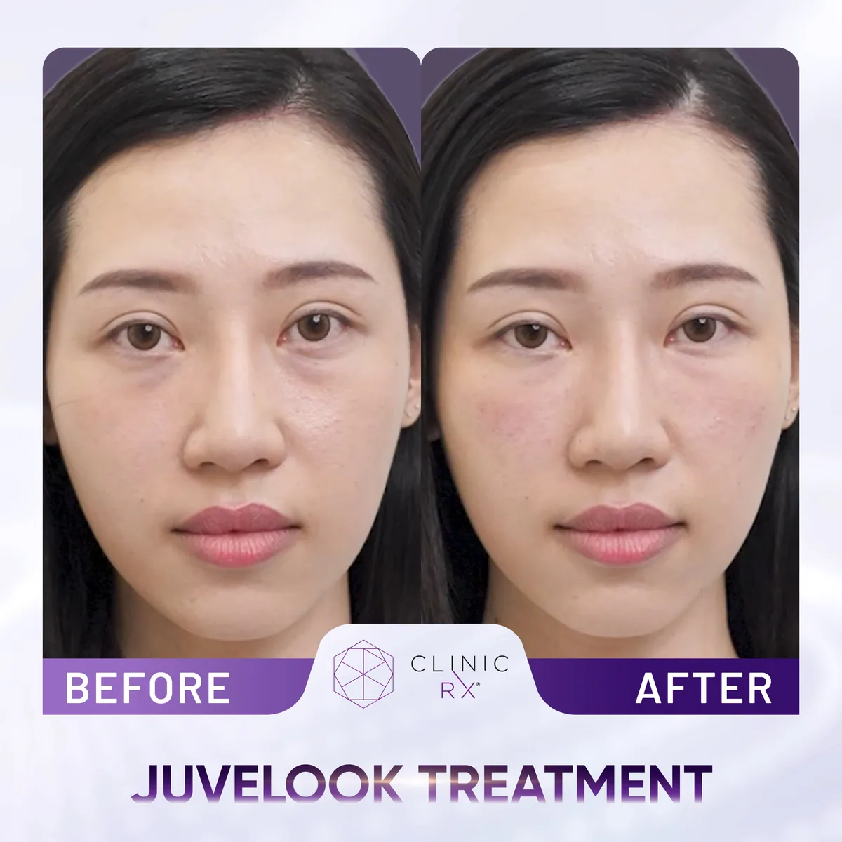 Juvelook actual result 4