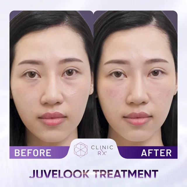 Juvelook actual result 4