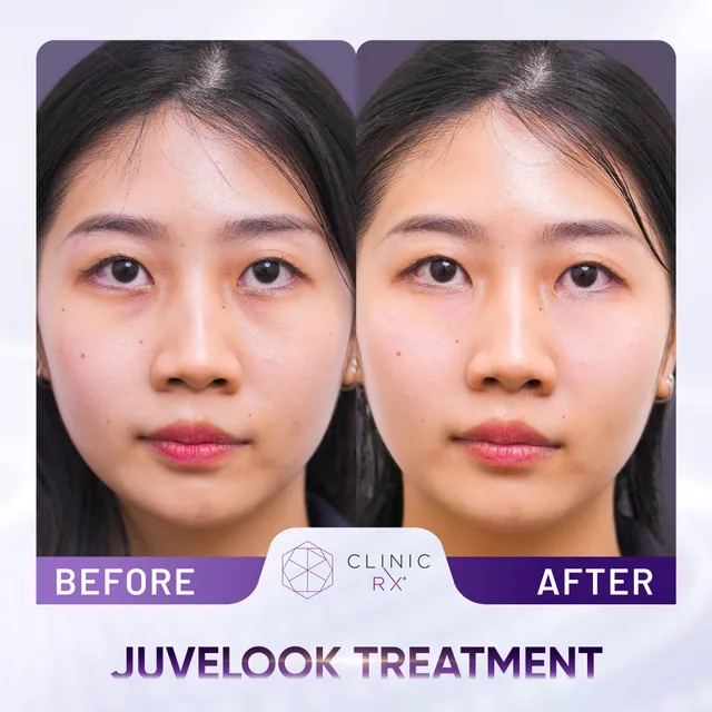 Juvelook actual result 5