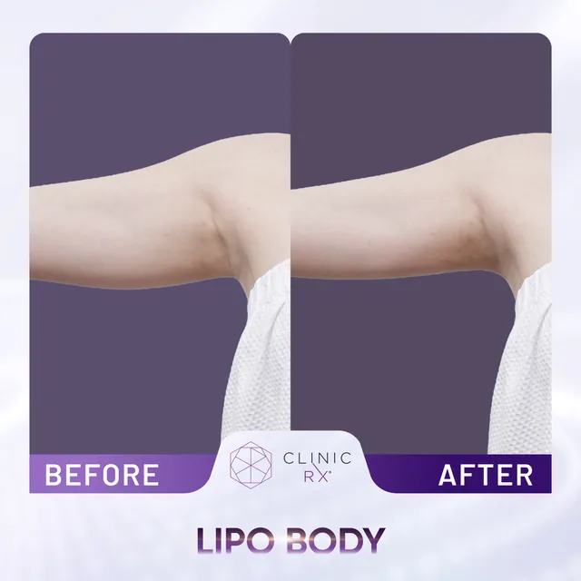 Lipo Body actual result 1