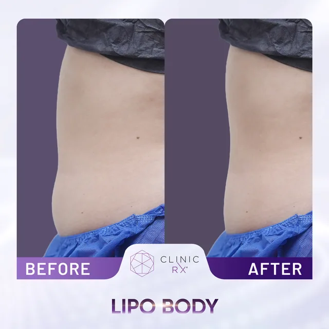 Lipo Body actual result 2