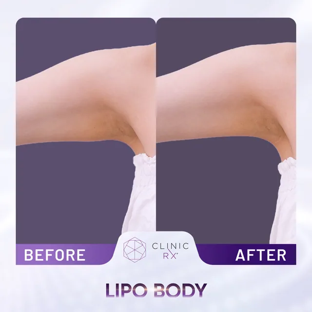 Lipo Body actual result 3