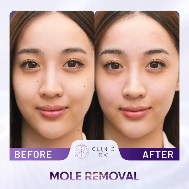 Milia & Mole Removal actual result 1