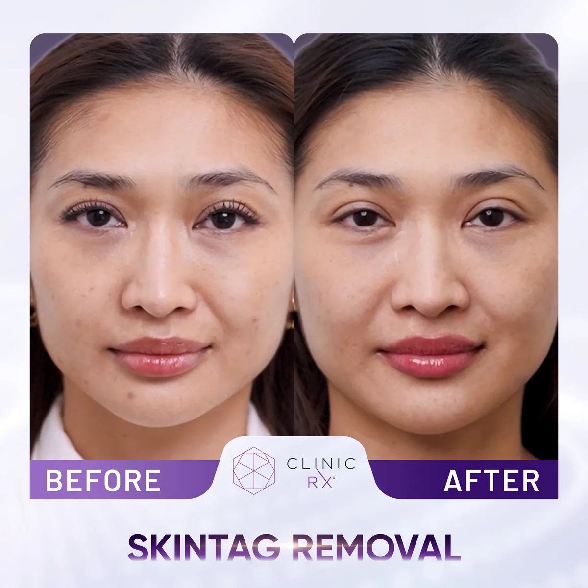 Milia & Mole Removal actual result 4