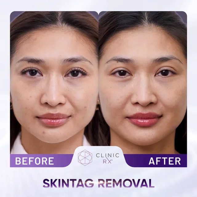 Milia & Mole Removal actual result 4