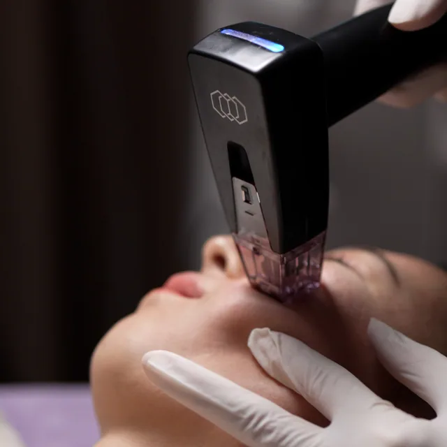 InMode Morpheus8 treatment step 3