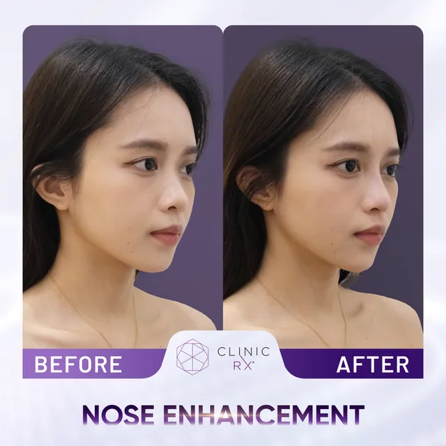 Nose Thread Lift actual result 1