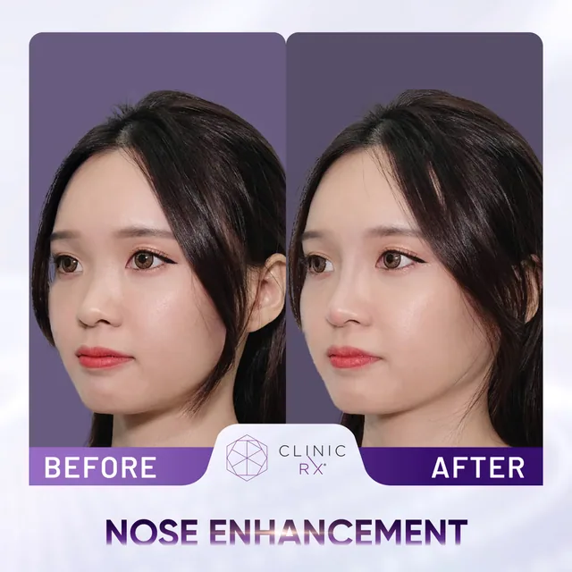 Nose Thread Lift actual result 2