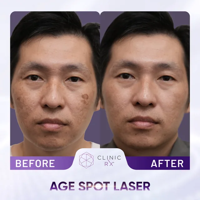 Pico Laser actual result 1