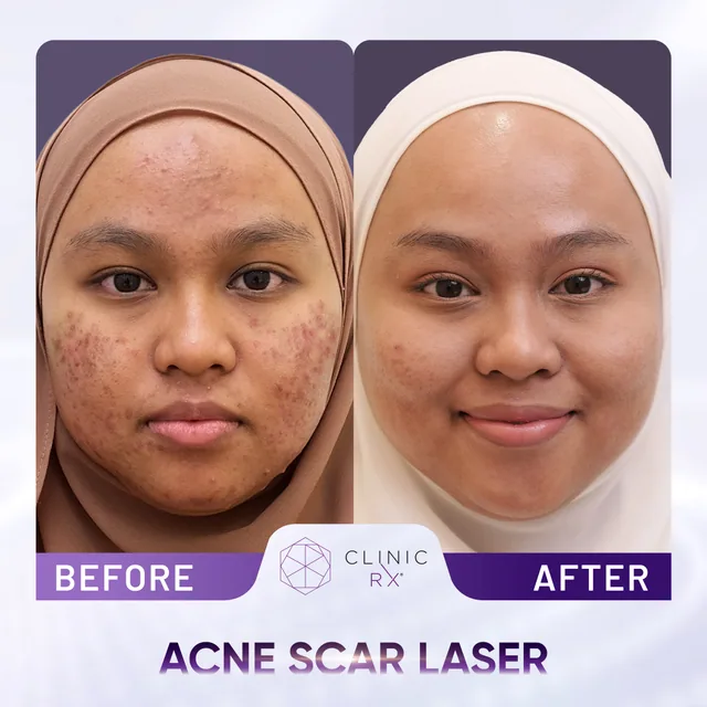 Pico Laser actual result 2