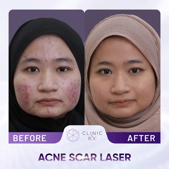 Pico Laser actual result 3