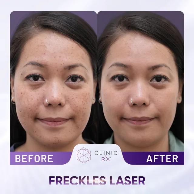 Pico Laser actual result 4