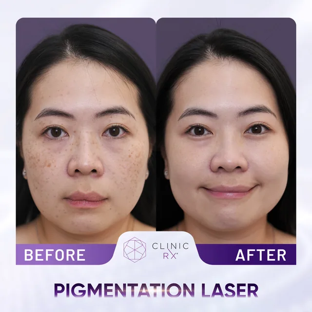 Pico Laser actual result 5