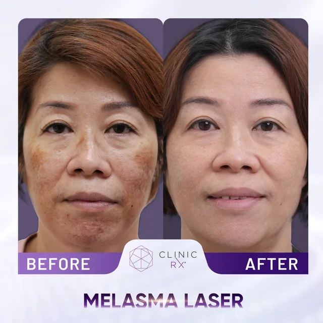 Pico Laser actual result 6