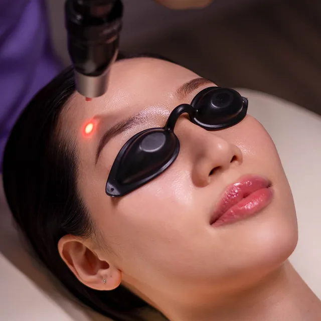 Pico Laser treatment step 3