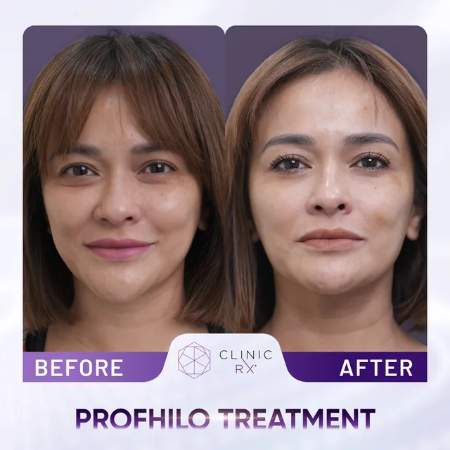 Profhilo actual result 1