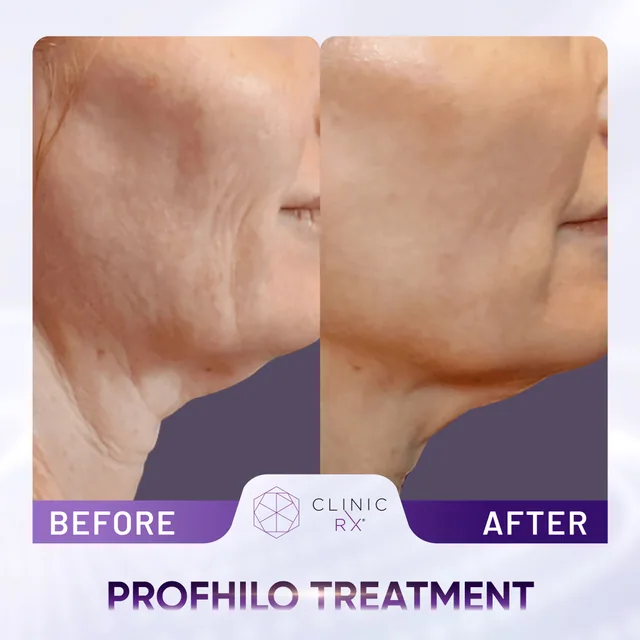 Profhilo actual result 2