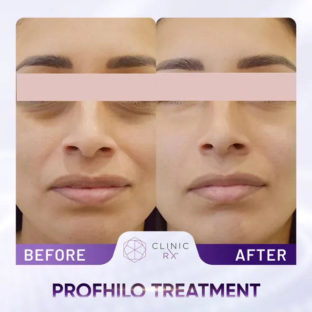 Profhilo actual result 3