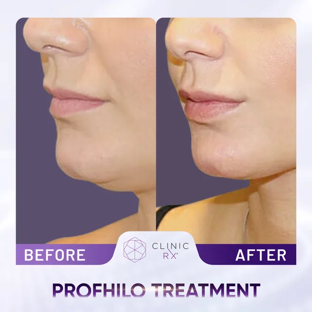 Profhilo actual result 4