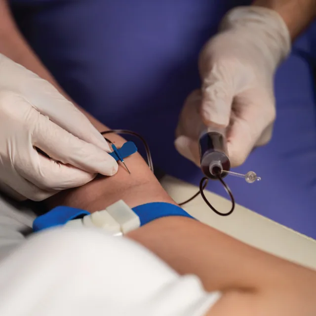 PRP Treatment treatment step 2
