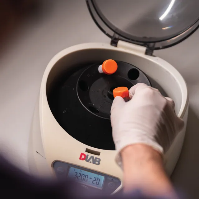 PRP Treatment treatment step 3