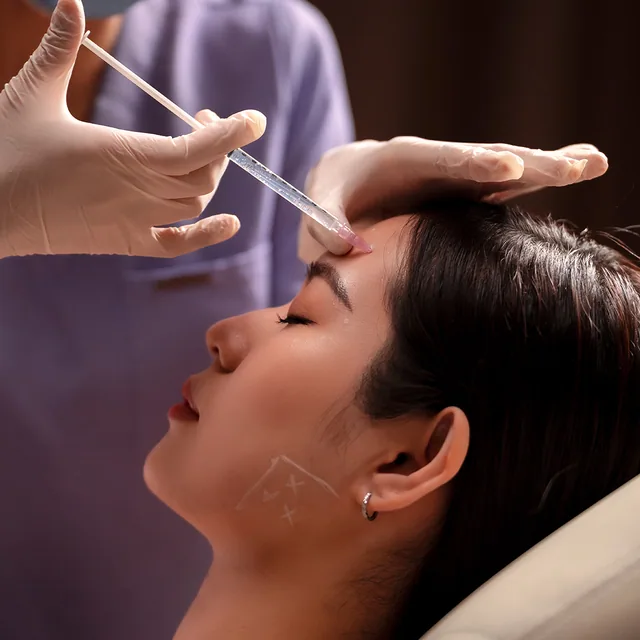 Radiesse treatment step 4