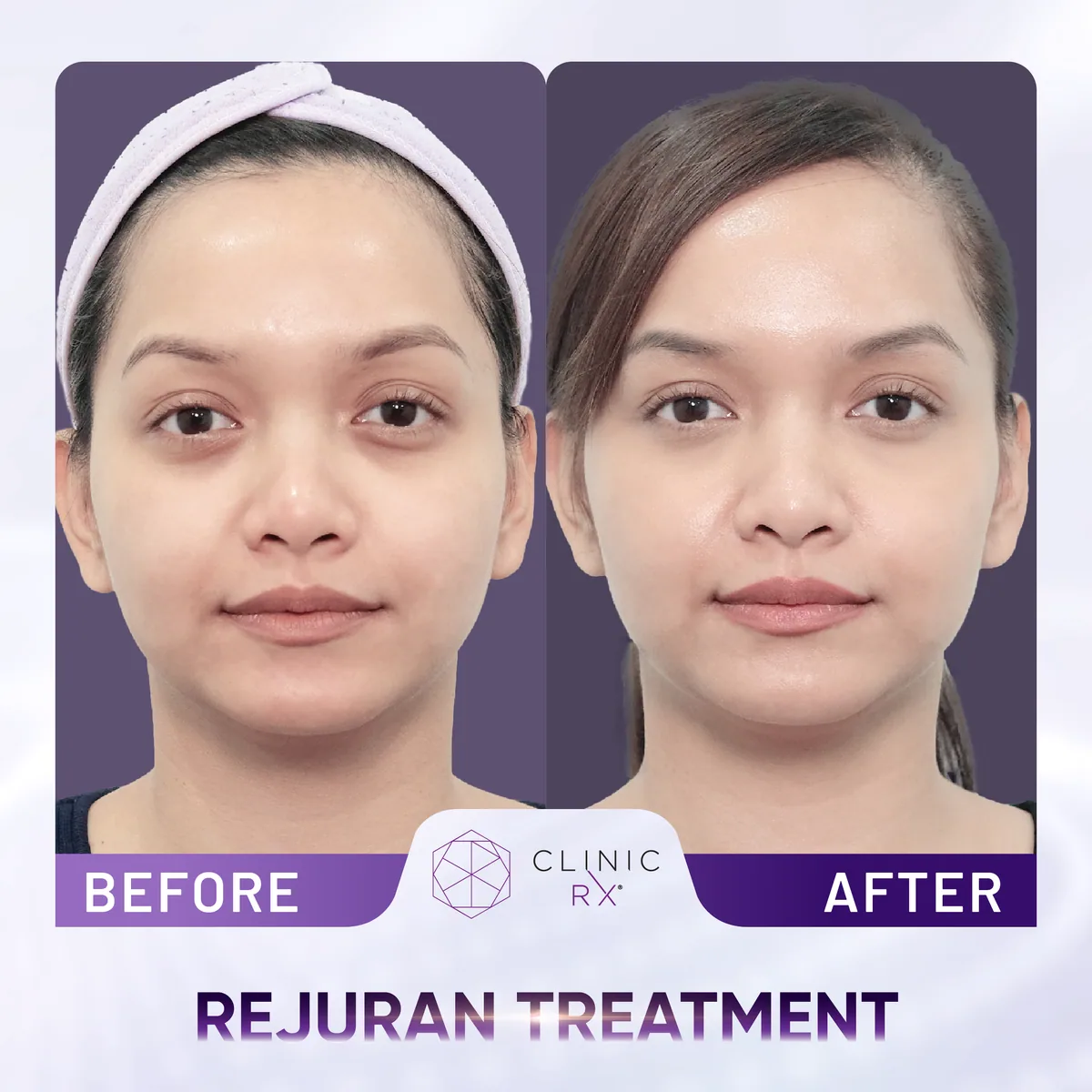 Rejuran actual result 1