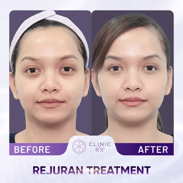 Rejuran actual result 1