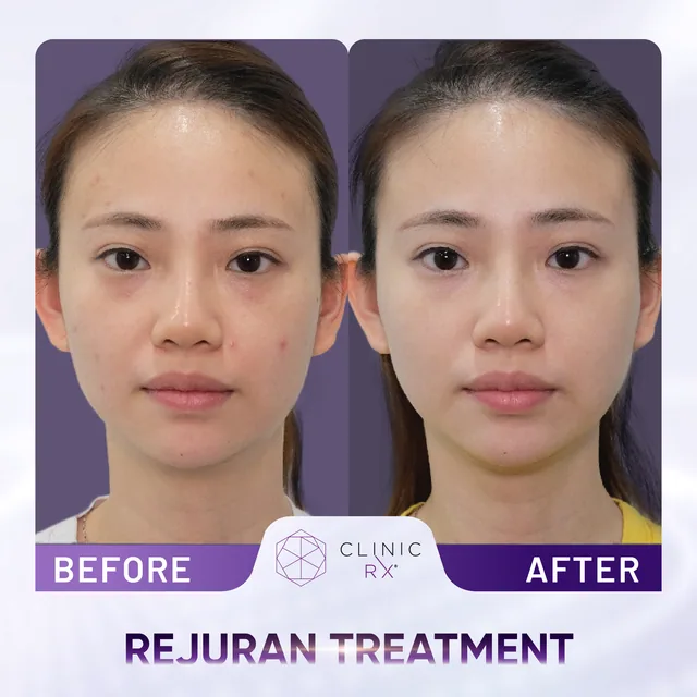 Rejuran actual result 2