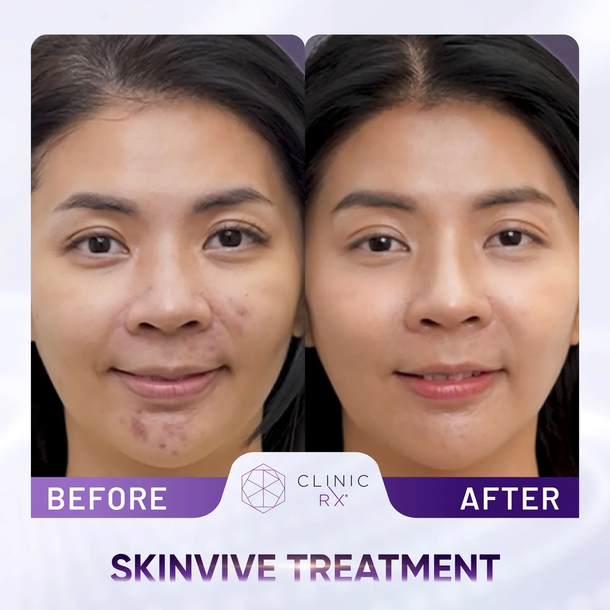Skinvive actual result 1