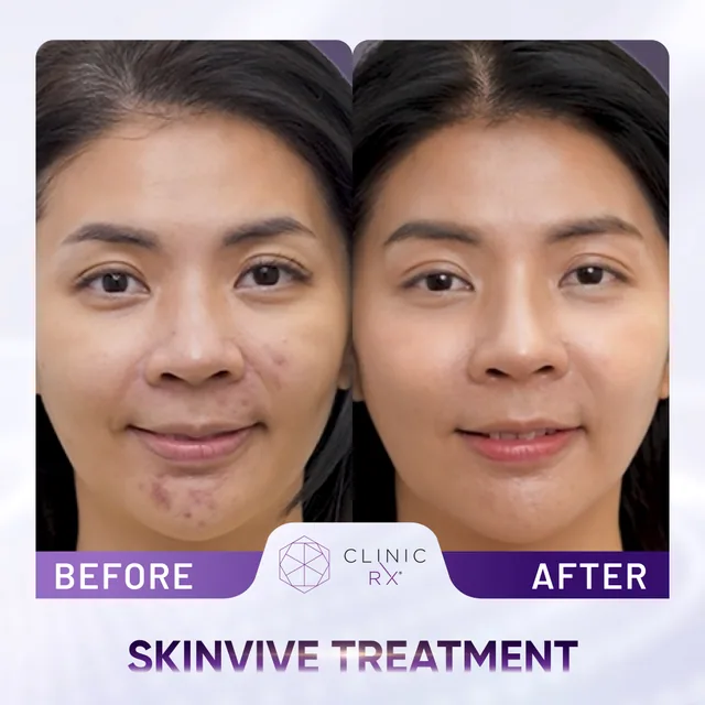 Skinvive actual result 1