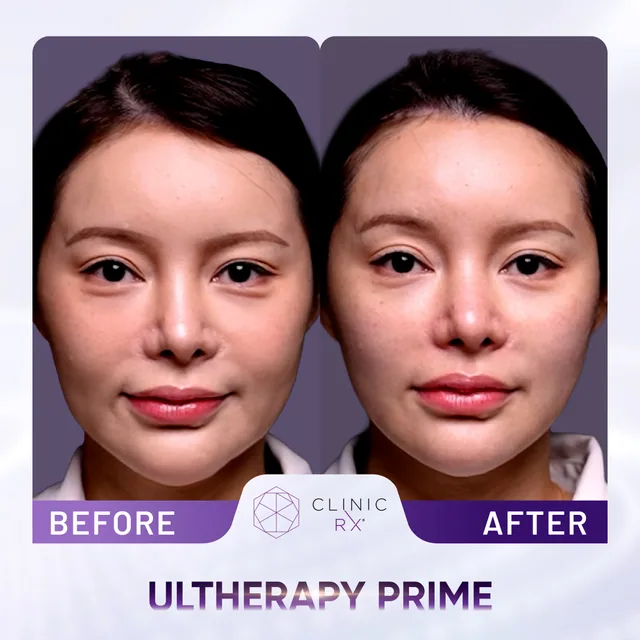 Ultherapy Prime actual result 1