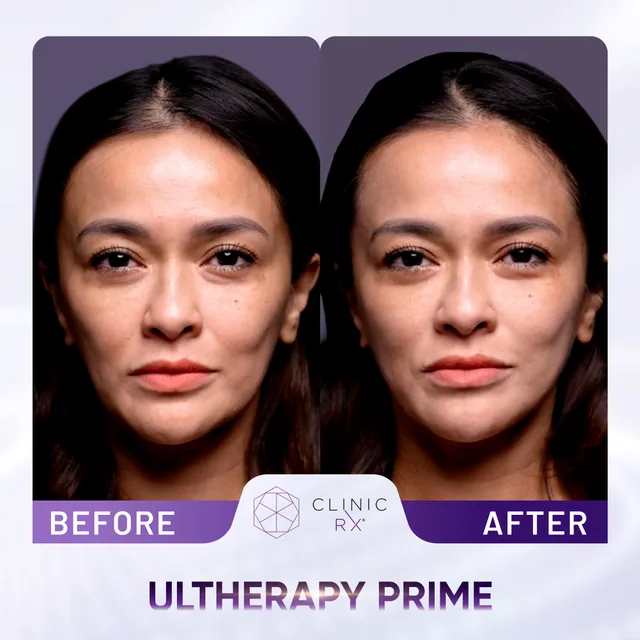 Ultherapy Prime actual result 2